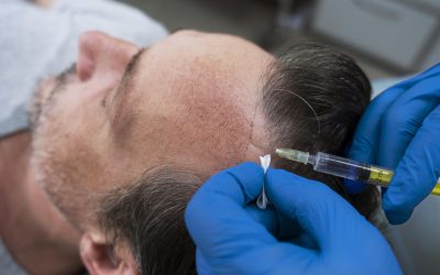 PRP capelli: come funziona, quando farlo e perché è fondamentale anche dopo il trapianto